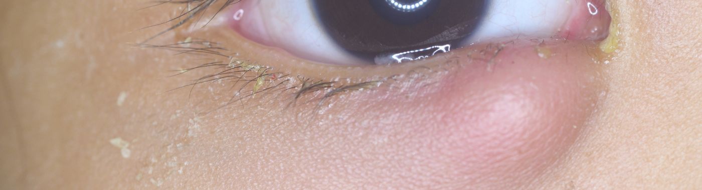 Periorbital Cellulitis - Causes, Symptoms, Diagnosis, Treatment, and Prevention