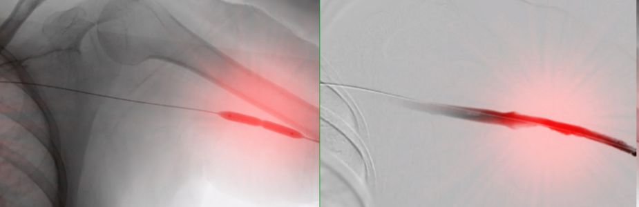 pci angioplasty with octivus guided stents.JPG