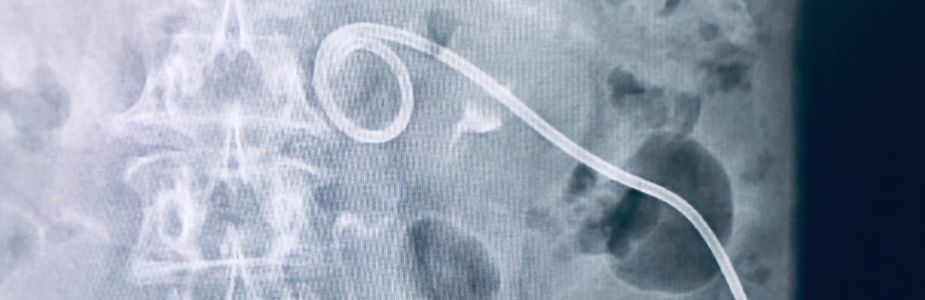 Percutaneous Nephrostomy (PCN) / Stent Placement