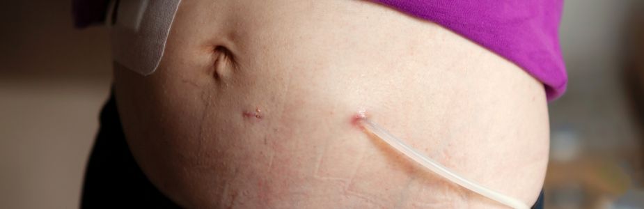 Peritoneal Dialysis / CAPD