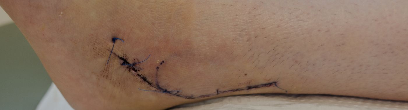 Peroneal Nerve Injury - Causes, Symptoms, Diagnosis, Treatment, and Prevention