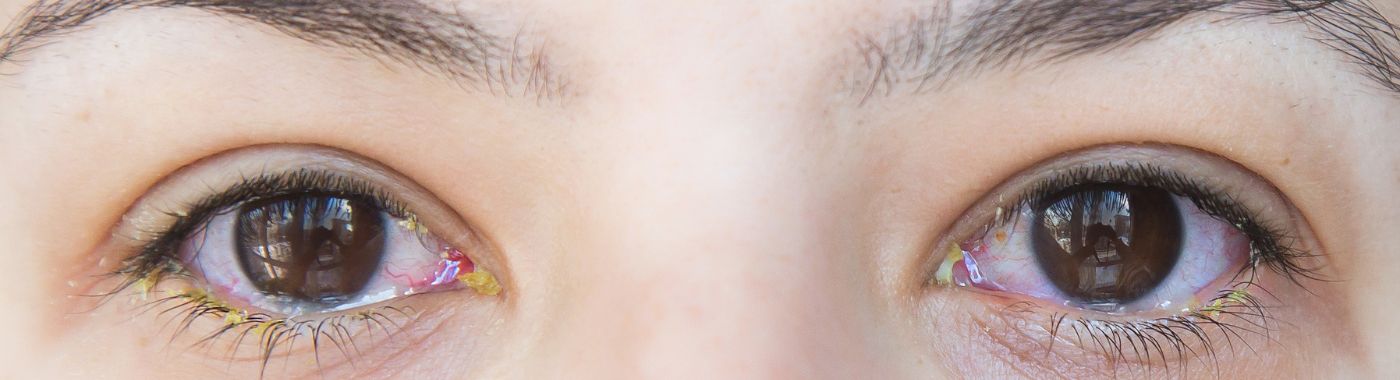 Phthisis Bulbi - Causes, Symptoms, Diagnosis, Treatment, and Prevention