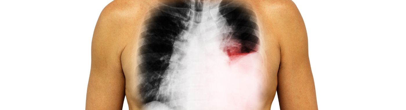 Pleural Effusion - Causes, Symptoms, Diagnosis, Treatment, and Prevention