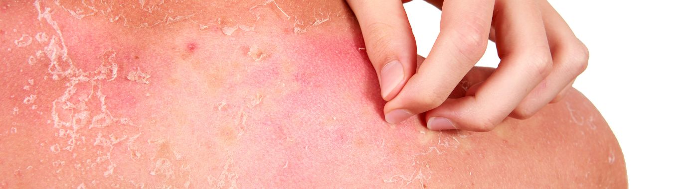 Radiation Burns - Causes, Symptoms, Diagnosis, Treatment, and Prevention