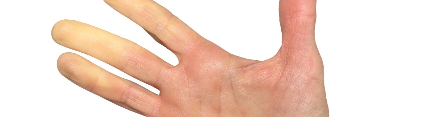 Reversible Cerebral Vasoconstriction Syndrome - Causes, Symptoms, Diagnosis, Treatment, and Prevention