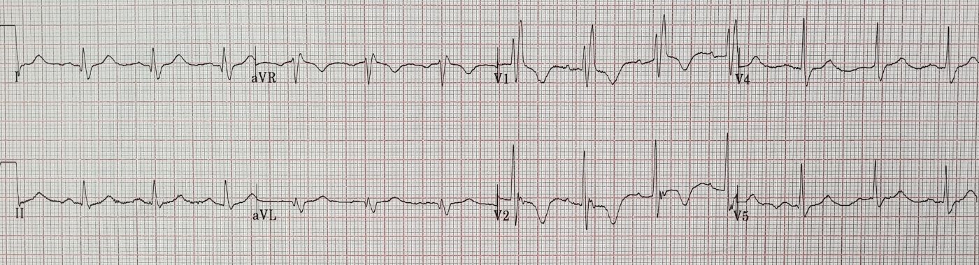 Right Bundle Branch Block - Causes, Symptoms, Diagnosis, Treatment, and Prevention