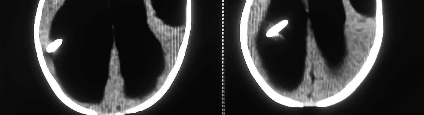 Schizencephaly - Causes, Symptoms, Diagnosis, Treatment, and Prevention