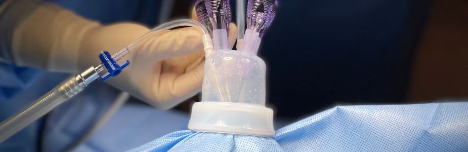 SILS (Single-Incision Laparoscopic Surgery)