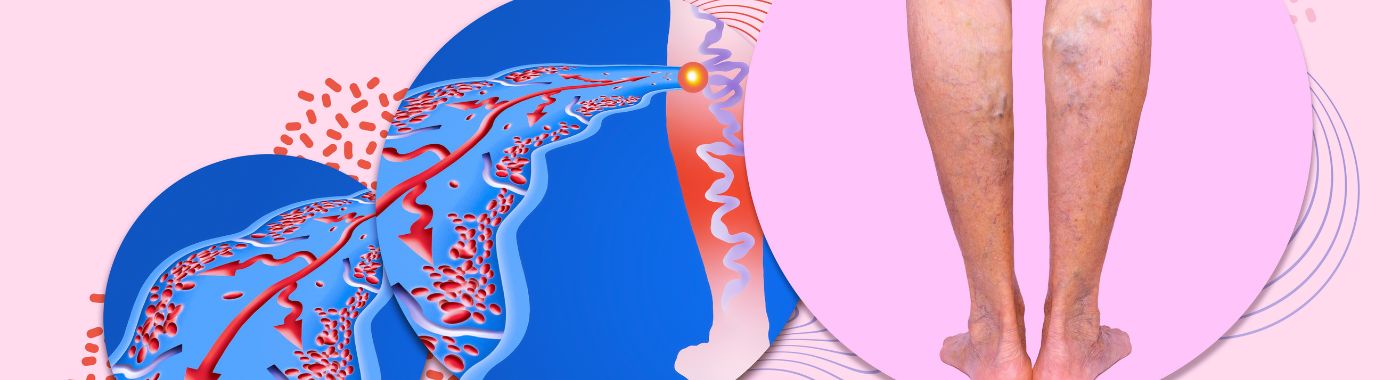 Smv Thrombosis - Causes, Symptoms, Diagnosis, Treatment, and Prevention