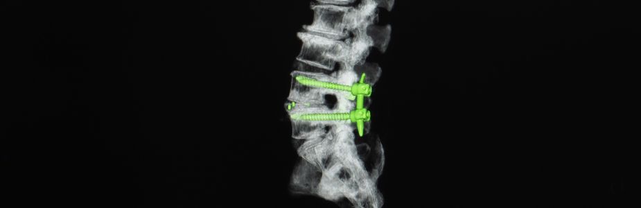 Spinal Fusion / Instrumented Fusion