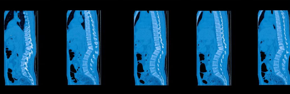 Spinal Trauma / Fracture Fixation