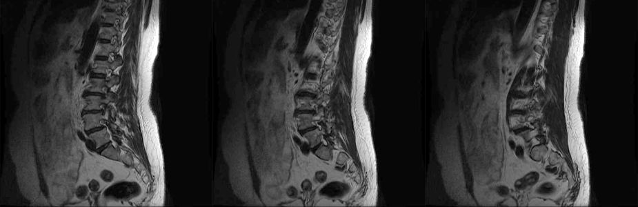 Spinal Tumour Surgeries