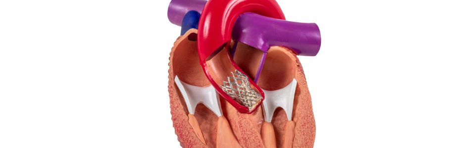 tavr tavi transcatheter aortic valve replacement.jpg