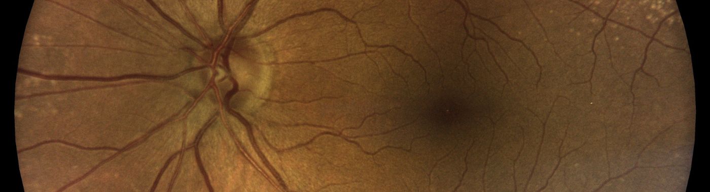 Terriens Marginal Degeneration - Causes, Symptoms, Diagnosis, Treatment, and Prevention