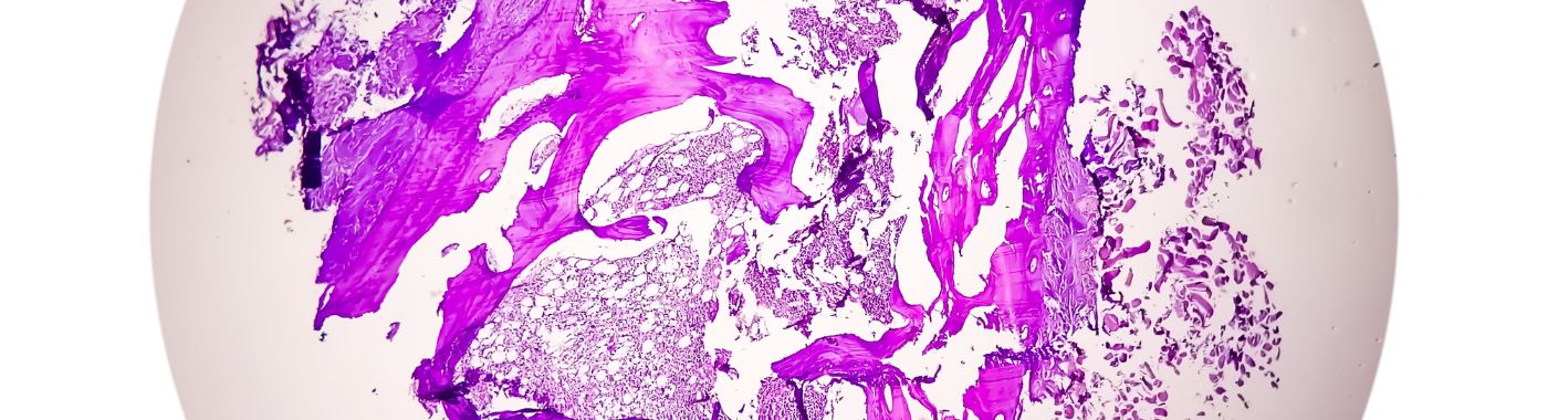 Thyroglossal Duct Cysts - Causes, Symptoms, Diagnosis, Treatment, and Prevention