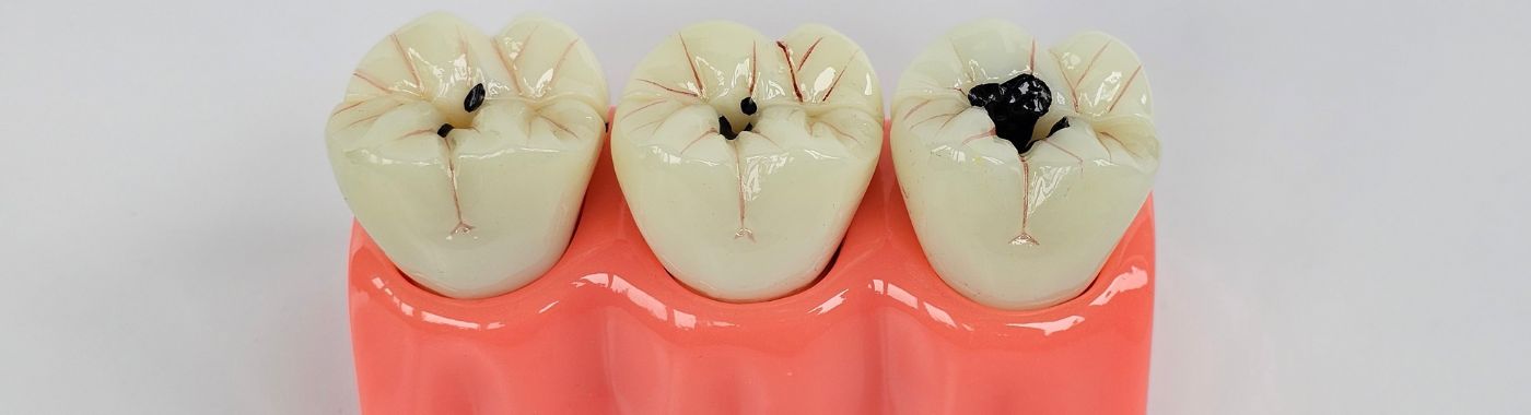 Tooth Decay - Causes, Symptoms, Diagnosis, Treatment, and Prevention