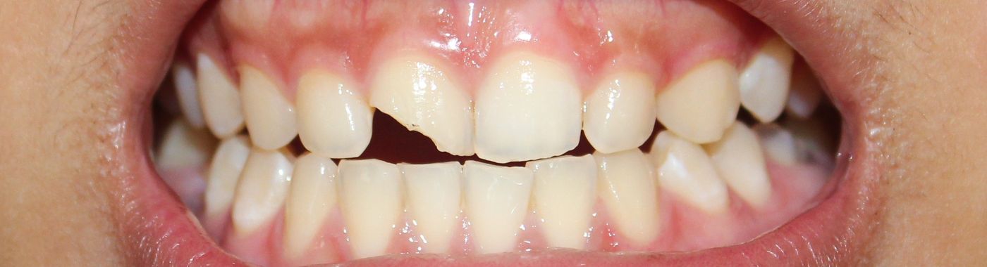 Tooth Luxation - Causes, Symptoms, Diagnosis, Treatment, and Prevention