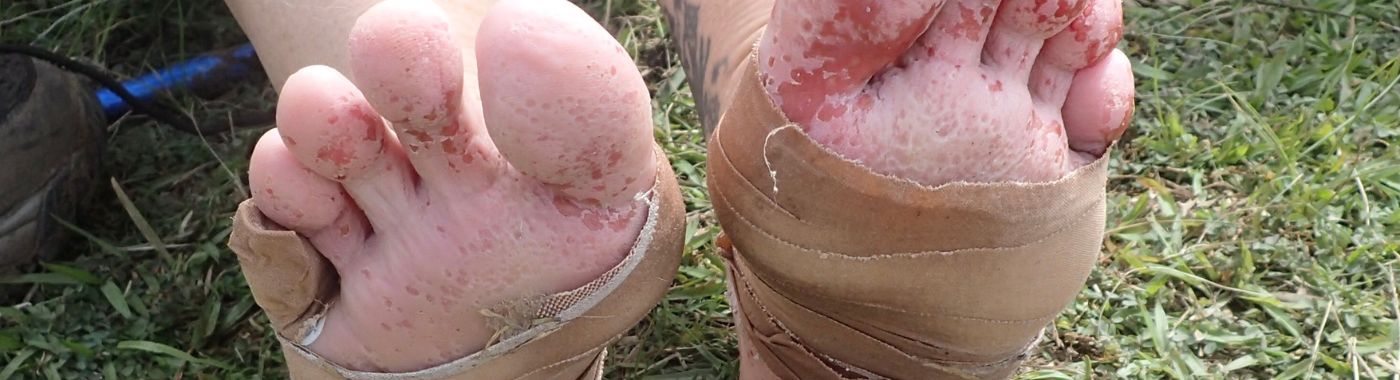 Trench Foot - Causes, Symptoms, Diagnosis, Treatment, and Prevention