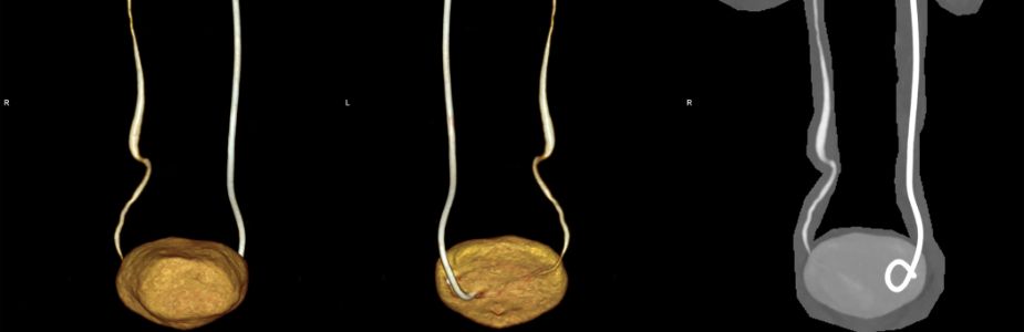 Ureteral Stenting / Double-J Stents