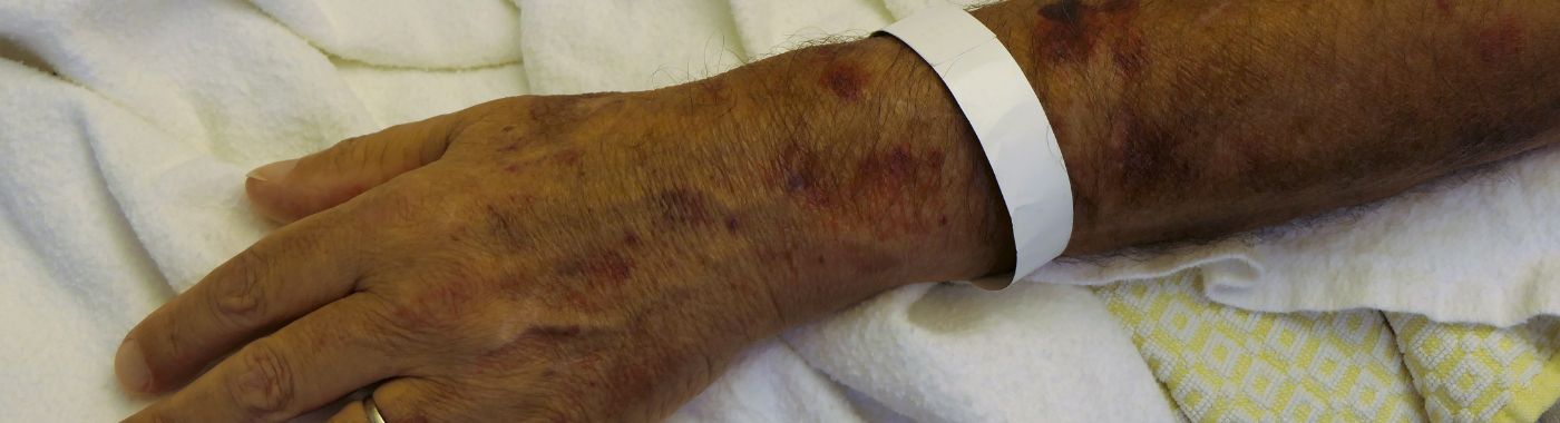 Wiskott Aldrich Syndrome - Causes, Symptoms, Diagnosis, Treatment, and Prevention