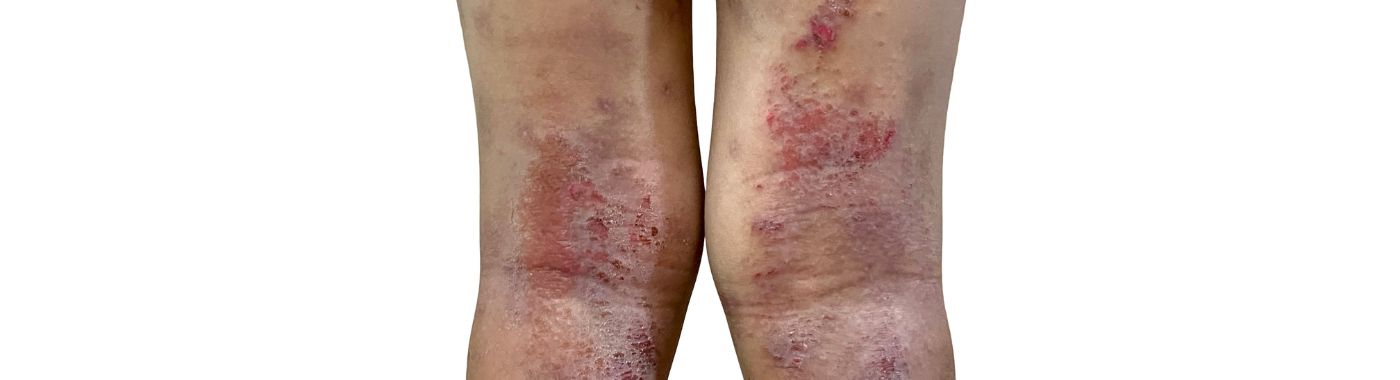 Yaws - Causes, Symptoms, Diagnosis, Treatment, and Prevention