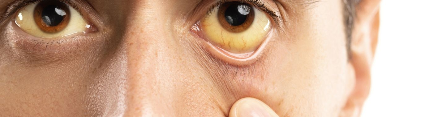 Yellow Fever - Causes, Symptoms, Diagnosis, Treatment, and Prevention