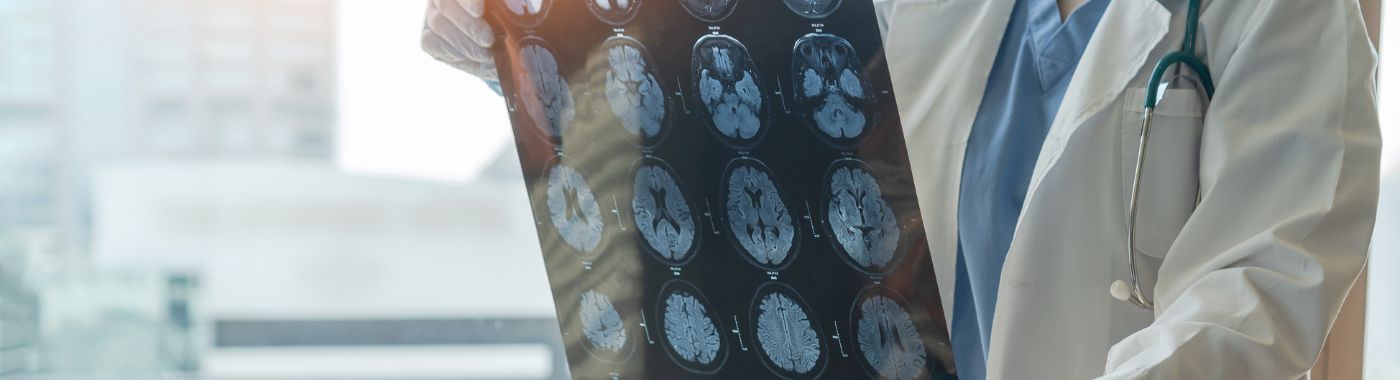 Alexander Disease - Causes, Symptoms, Diagnosis, Treatment, and Prevention