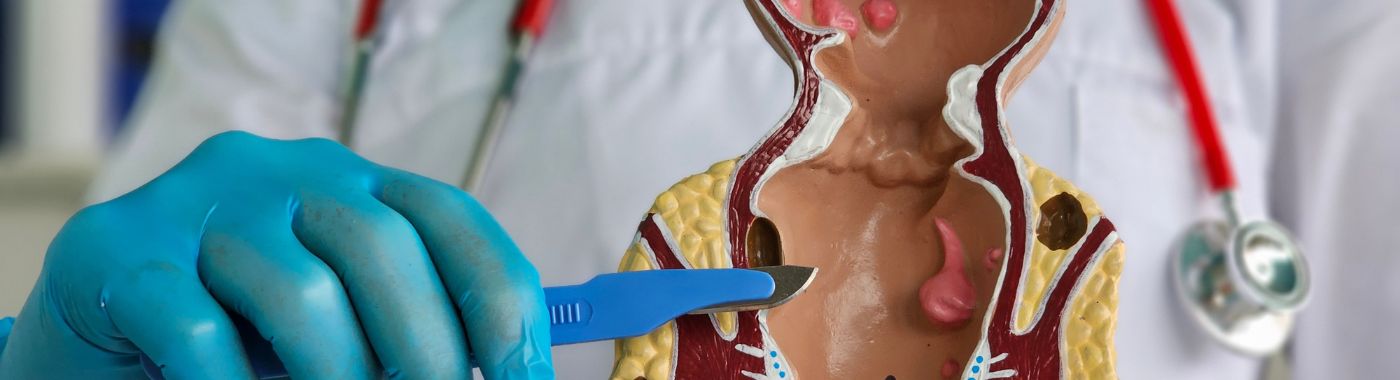 Anorectal Malformation - Causes, Symptoms, Diagnosis, Treatment, and Prevention