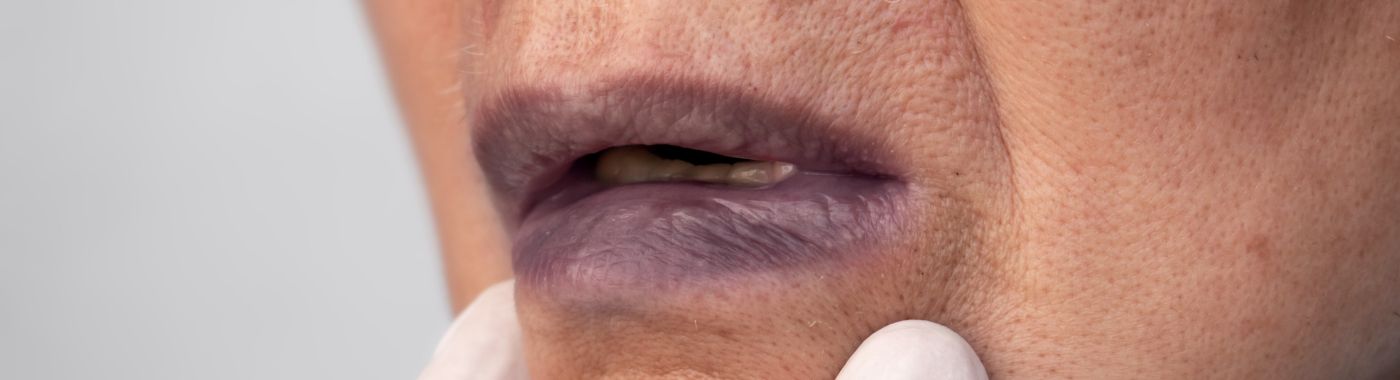 Argyria - Causes, Symptoms, Diagnosis, Treatment, and Prevention