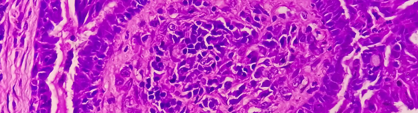 Atypical Endometrial Hyperplasia - Causes, Symptoms, Diagnosis, Treatment, and Prevention