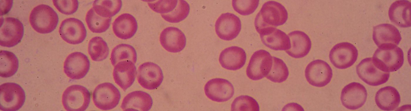 Beta Thalassemia - Causes, Symptoms, Diagnosis, Treatment, and Prevention