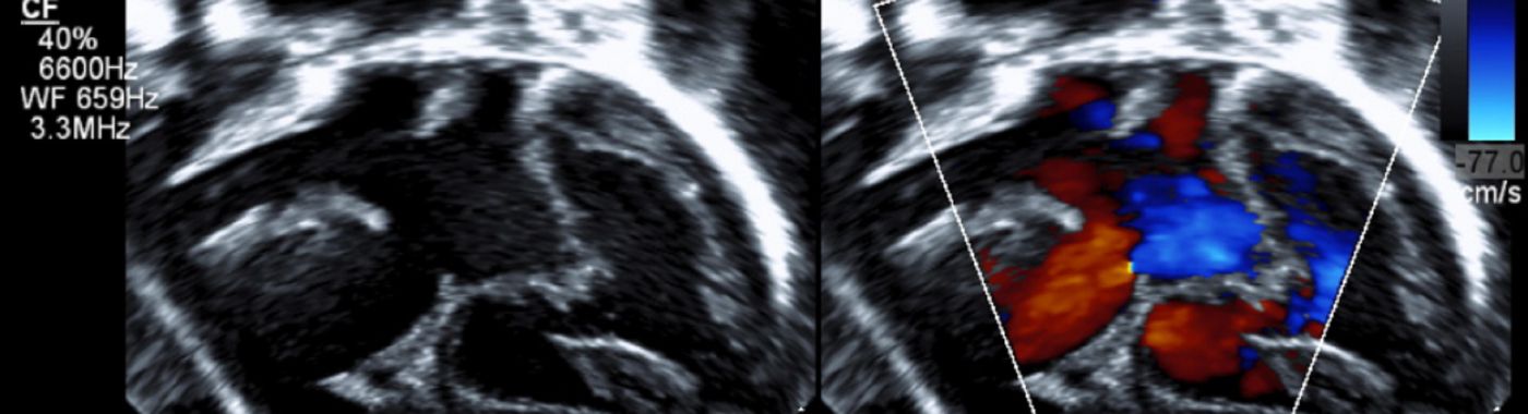 Bicuspid Aortic Valve - Causes, Symptoms, Diagnosis, Treatment, and Prevention