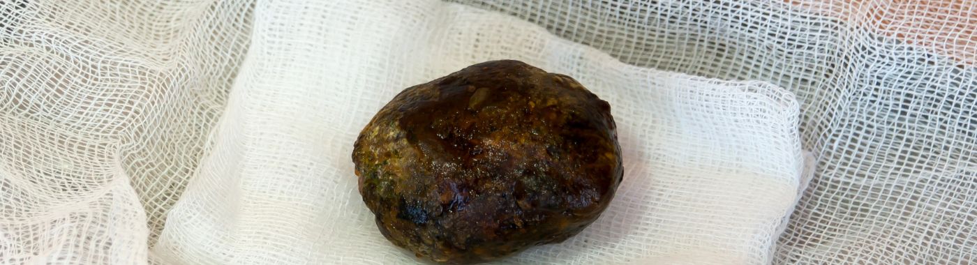 Biliary Stricture - Causes, Symptoms, Diagnosis, Treatment, and Prevention