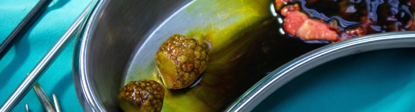 Bladder Stones - Causes, Symptoms, Diagnosis, Treatment, and Prevention