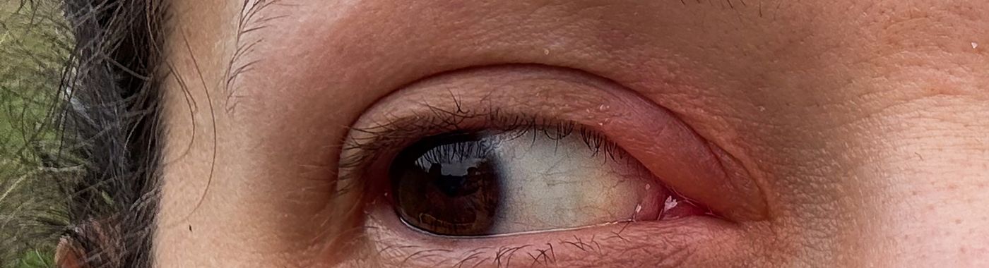 Blepharitis (Eyelid Inflammation): Causes & Treatment