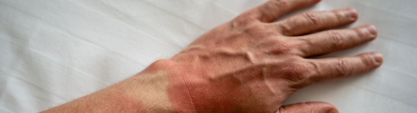 Bloom Syndrome - Causes, Symptoms, Diagnosis, Treatment, and Prevention