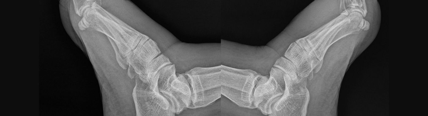 Blounts Disease - Causes, Symptoms, Diagnosis, Treatment, and Prevention