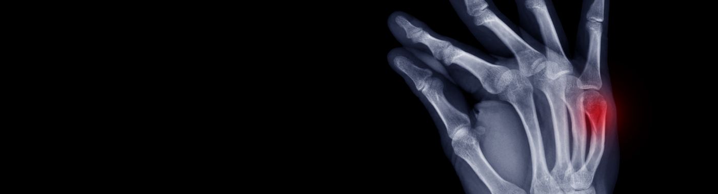 Boxers Fracture - Causes, Symptoms, Diagnosis, Treatment, and Prevention