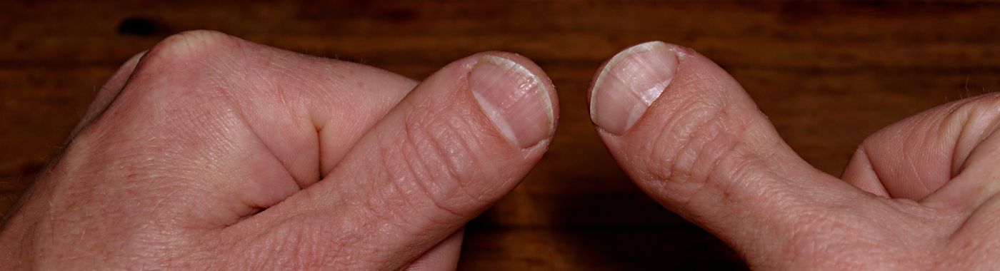 Brachydactyly - Causes, Symptoms, Diagnosis, Treatment, and Prevention