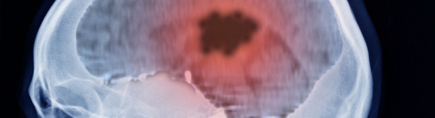 Brain Abscess - Causes, Symptoms, Diagnosis, Treatment, and Prevention