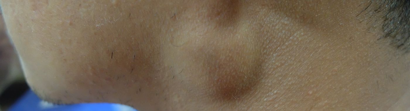 Branchial Cleft Cyst - Causes, Symptoms, Diagnosis, Treatment, and Prevention