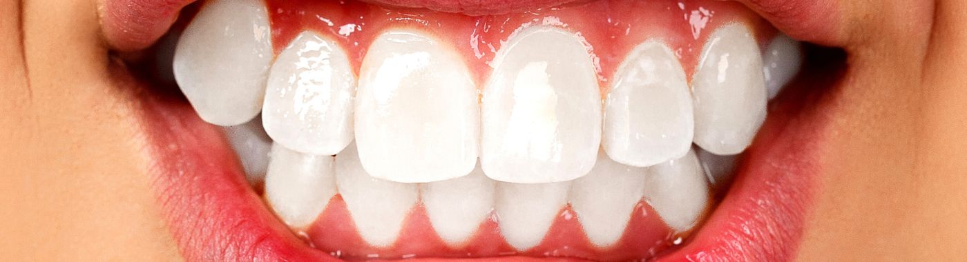 Bruxism - Causes, Symptoms, Diagnosis, Treatment, and Prevention