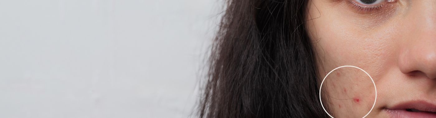 Eczema On Face - Causes, Symptoms, Diagnosis, Treatment, and Prevention