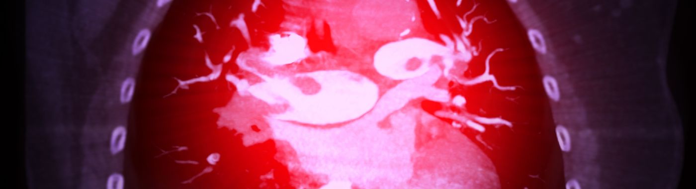 Embolism - Causes, Symptoms, Diagnosis, Treatment, and Prevention