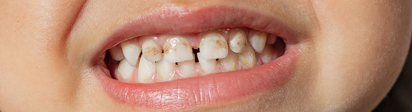 Enamel Hypoplasia - Causes, Symptoms, Diagnosis, Treatment, and Prevention