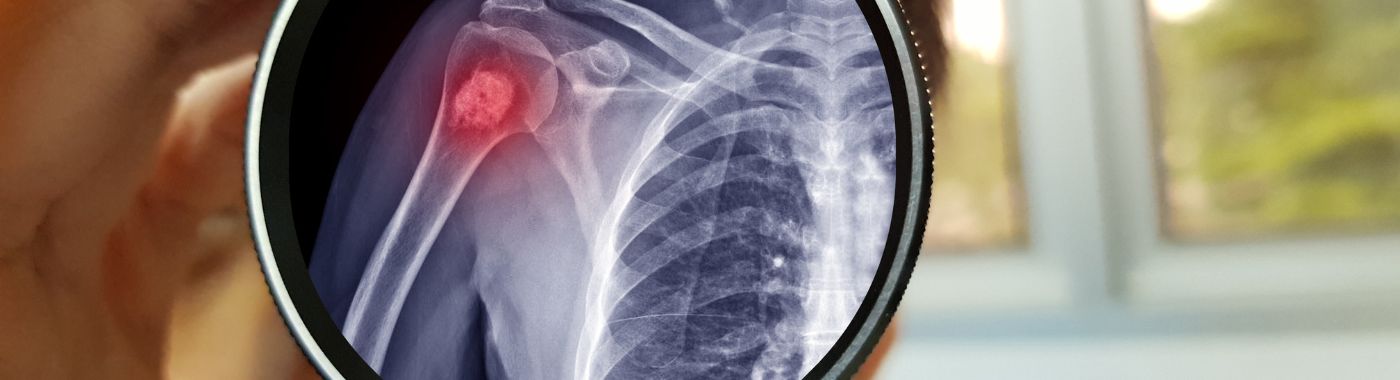 Enchondroma - Causes, Symptoms, Diagnosis, Treatment, and Prevention