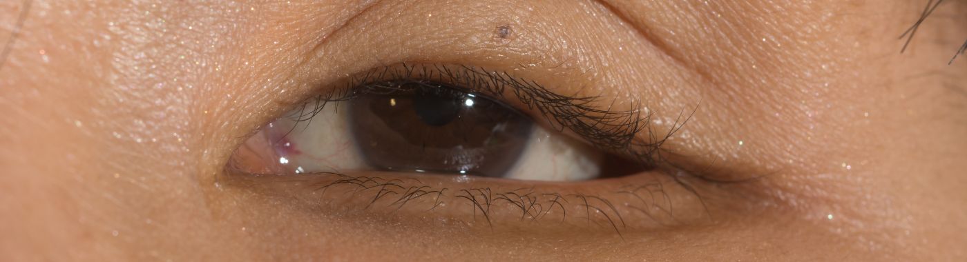 Enophthalmos - Causes, Symptoms, Diagnosis, Treatment, and Prevention