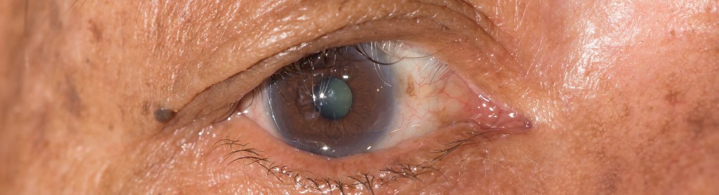 Entropion - Causes, Symptoms, Diagnosis, Treatment, and Prevention