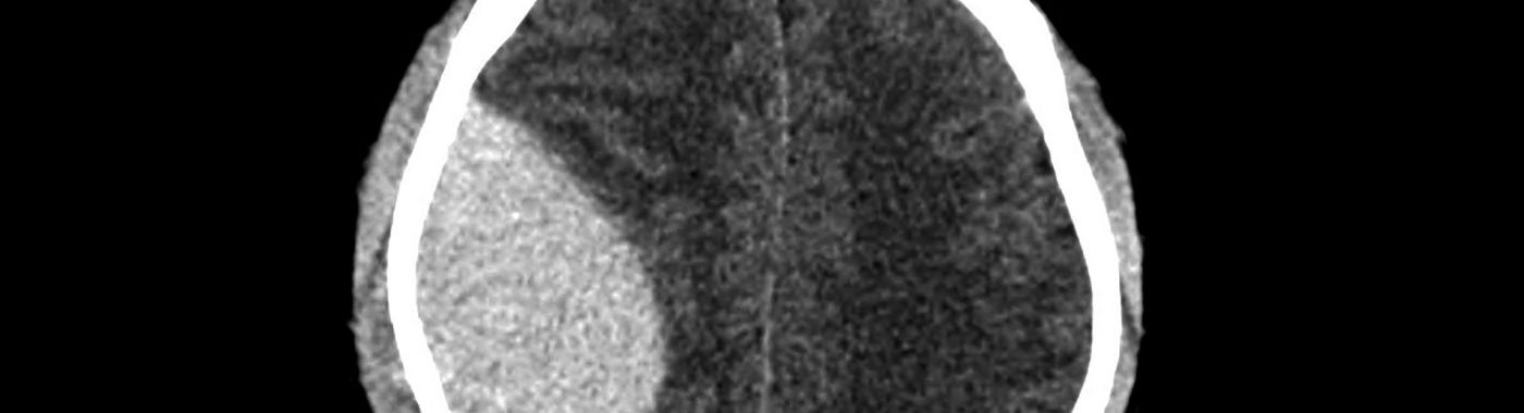 Epidural Hematoma - Causes, Symptoms, Diagnosis, Treatment, and Prevention