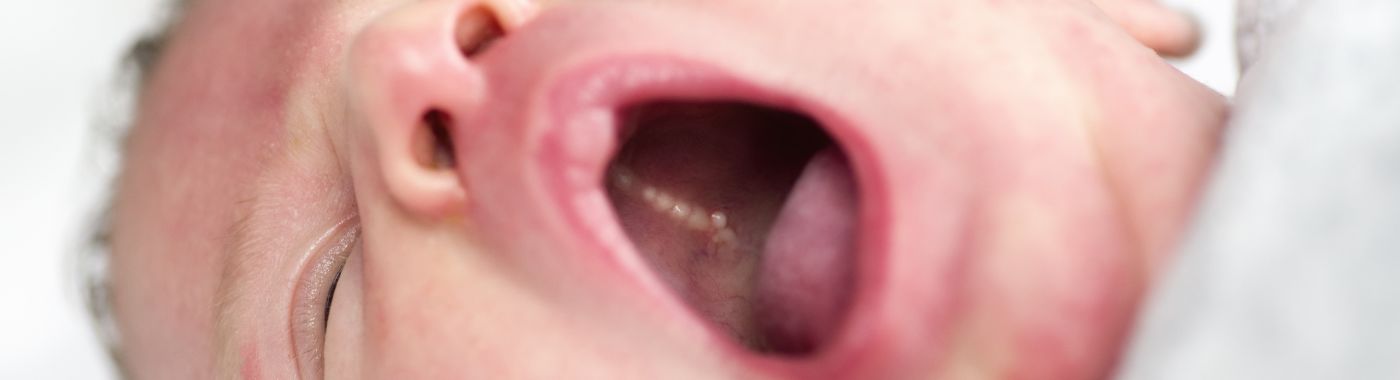 Epstein Pearls - Causes, Symptoms, Diagnosis, Treatment, and Prevention